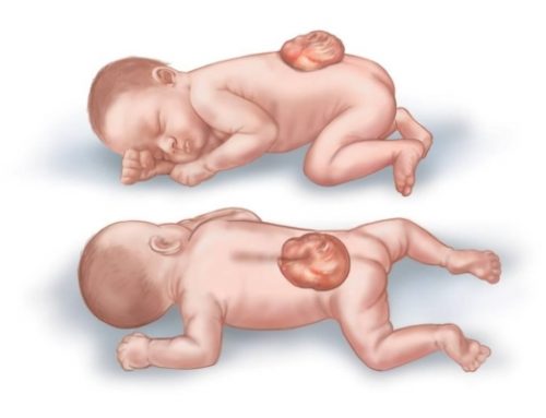 Dị tật bẩm sinh thai nhi. Giảm thiểu nguy cơ với 5-MTHF